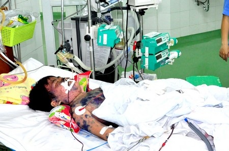 Một học sinh lớp 3 thập tử nhất sinh vì bệnh hư thận - 2 Cơ thể cháu Tường nổi nhiều bọng nước như bệnh thủy đậu