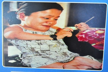 Quặn lòng trước những đứa trẻ da cam Việt Nam