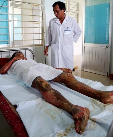 Một học sinh bị bỏng nặng khi đốt rẫy - 1 Em Luân đang điều trị tại Trung tâm y tế huyện Phú Ninh. Ảnh: H.P.