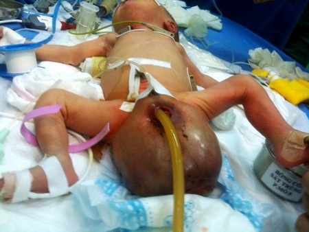 Hình ảnh khối u ở vùng mông của cháu bé khi mới sinh