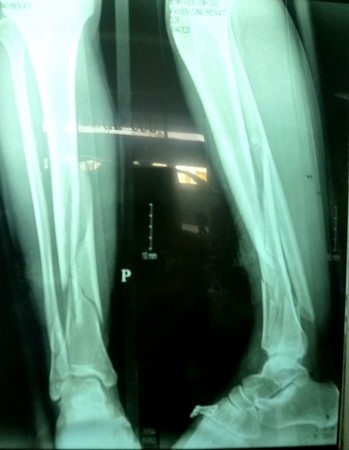 Hình phim bệnh nhân Nguyễn C.B. bị gãy 2 xương cẳng chân trái do ngã từ thang xuống đất