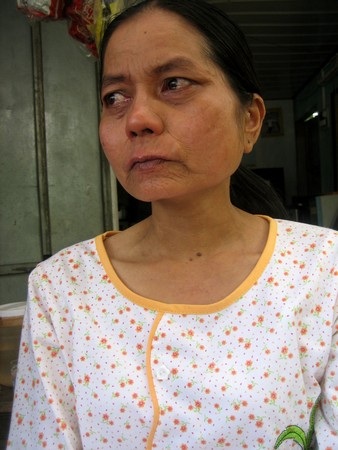 Cô gái trẻ mang gương mặt bà lão sẽ sang Đài Loan chữa bệnh