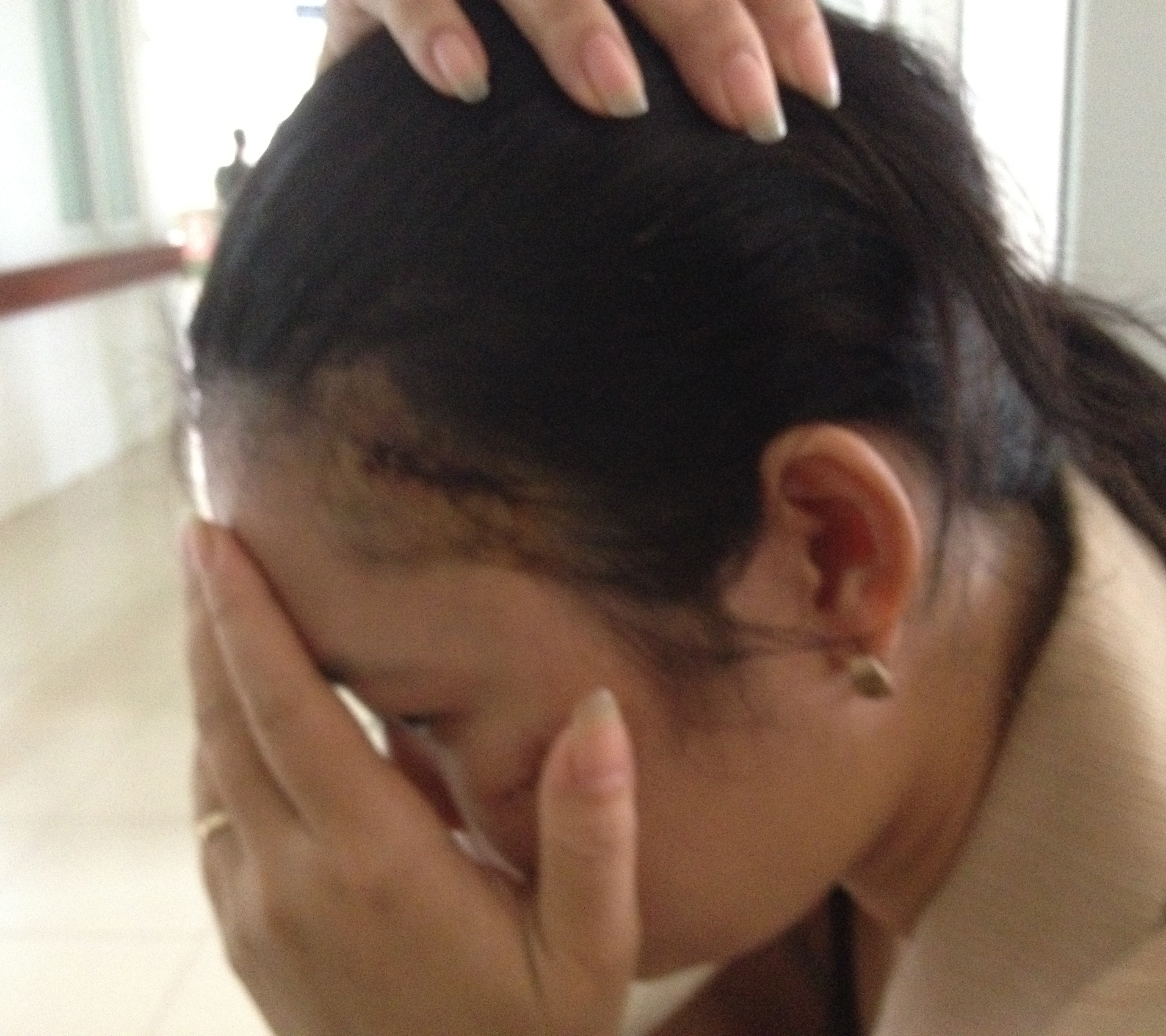 Chị Trần Thị Phượng ôm mặt vì những vết thương.