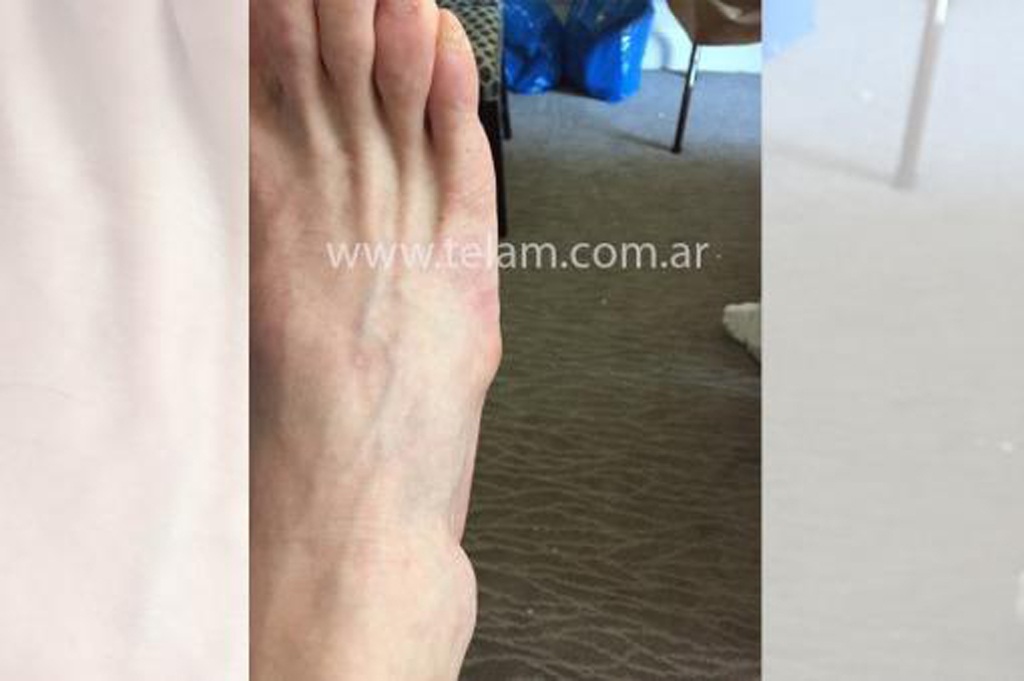 Cận cảnh chấn thương khiến Messi “ngồi chơi xơi nước” - 2 Chân phải của Messi sưng vù