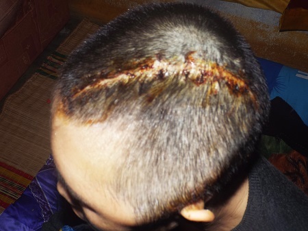 Các bác sỹ đã rạch một đường dài 30cm ở ngay trên đầu để hút 60g máu tụ trong não để cứu chị Trang.