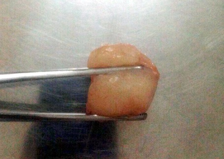 Hà Nội: Hóc vải, bé trai 6 tuổi tử vong thương tâm - 1 Quả vải gây ra cái chết thương tâm cho bé trai 6 tuổi