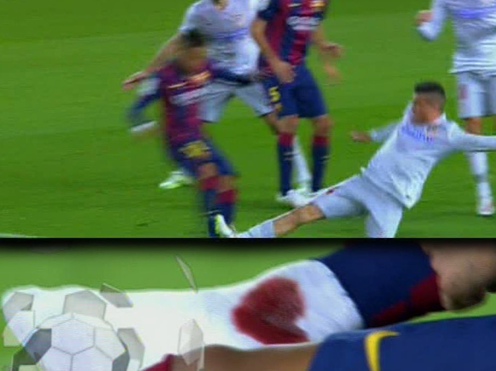 Cổ chân Neymar đẫm máu vì đòn triệt hạ của đối thủ - 1 Cổ chân đẫm
máu của Neymar