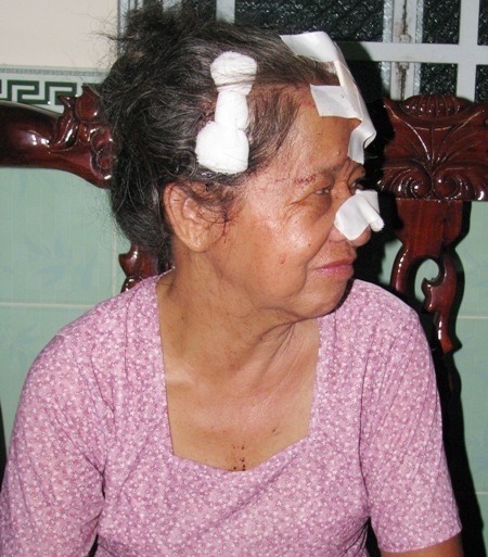 Phóng hỏa, chém người khiến 6 nạn nhân thương vong - 5 Bà Phe (60 tuổi) bị chém nặng nhất trong 5 nạn nhân. (Ảnh: Huỳnh Hải)