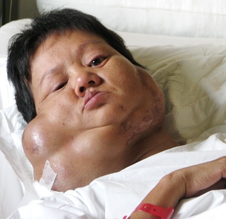 Bệnh nhân Huỳnh Lệ Hoa đã được phẫu thuật khối u - 1 Chị Hoa trước khi phẫu thuật.