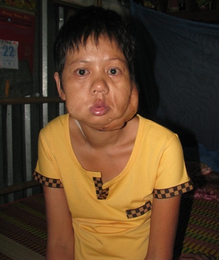 Chị Hoa sau khi phẫu thuật khối u bướu bên trái.