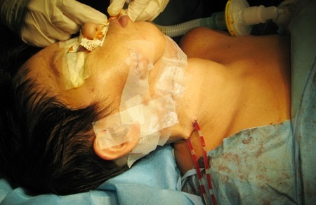 Bệnh nhân Huỳnh Lệ Hoa đã được phẫu thuật khối u - 5 Bệnh nhân sau phẫu thuật khối u.