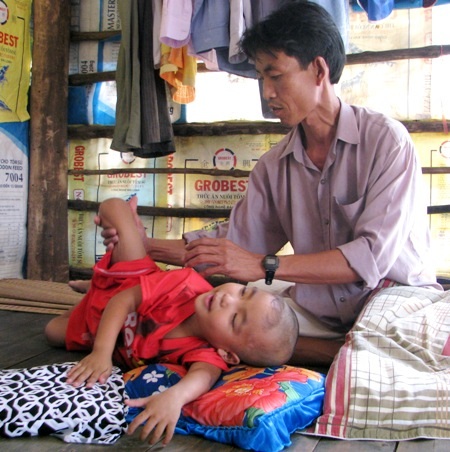 Đắng lòng trước khuôn mặt lanh lợi của cậu bé "ngồi cũng bị ngã" - 2 Từ ngày bị tai nạn, cậu bé Đầy chỉ có thể nằm quặt quẹo trong sự chăm sóc của cha.