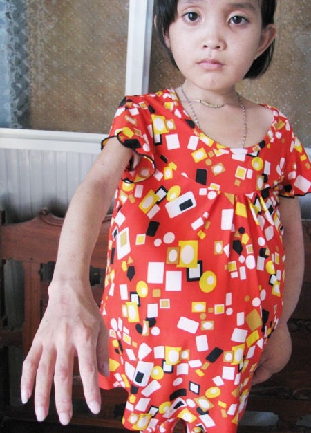 Thương bé lớp 5 với cơ thể dị dạng "tay to, bụng bự" - 2 Trong khi cánh tay phải lại ốm yếu hơn.