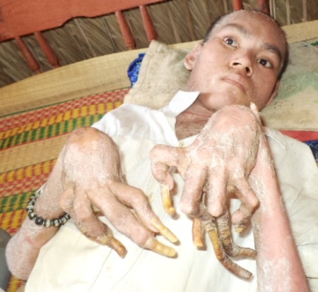 Móng tay dài ra bất thường.