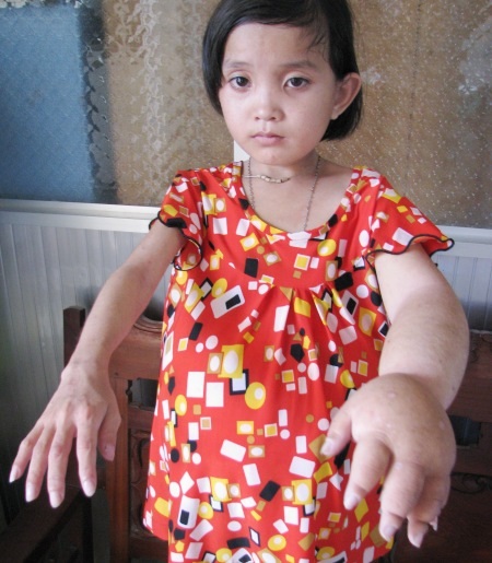 Thương bé lớp 5 với cơ thể dị dạng "tay to, bụng bự" - 3 Trong khi cánh tay phải lại ốm yếu hơn.
