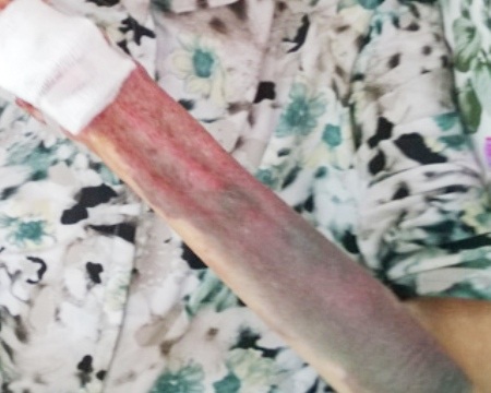 Một cánh tay của cụ bà bị thương.