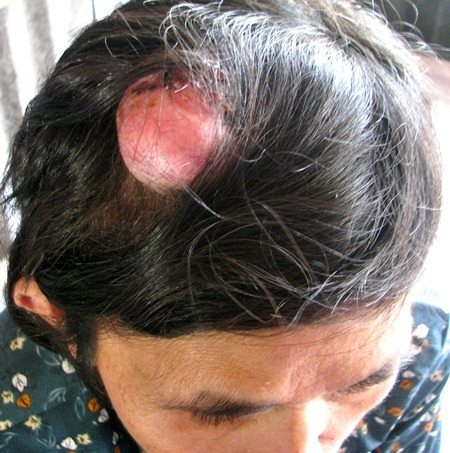 Cuộc sống tạm bợ của mẹ và con trong túp lều rách - 2 Bà Nga với khối u trên đầu đã nhiều năm nay hành hạ bà đau nhức lắm.