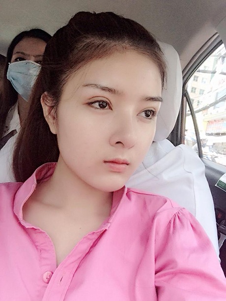 Cách đây không lâu, cô chia sẻ những bức ảnh có khuôn mặt lạ, khóe mắt vẫn còn sưng vì PTTM