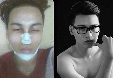 Giới trẻ Việt ngày càng “thoáng” hơn với phẫu thuật thẩm mỹ? - 6 Chàng trai PTTM để thỏa ước mơ làm người mẫu