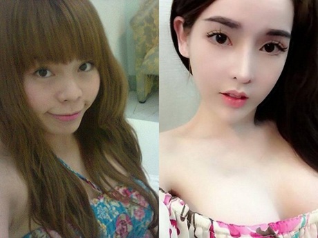 Giới trẻ Việt ngày càng “thoáng” hơn với phẫu thuật thẩm mỹ? - 2 Vân Tokyo trước và sau khi PTTM