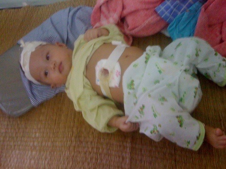 Sinh ra không có hậu môn, bé Chiến được phẫu thuật bên hông để đưa chất thải ra ngoài.