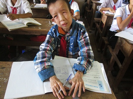 Cậu bé tật nguyền dùng việc học quên đi nỗi đau - 2 Lộc trong lớp học.