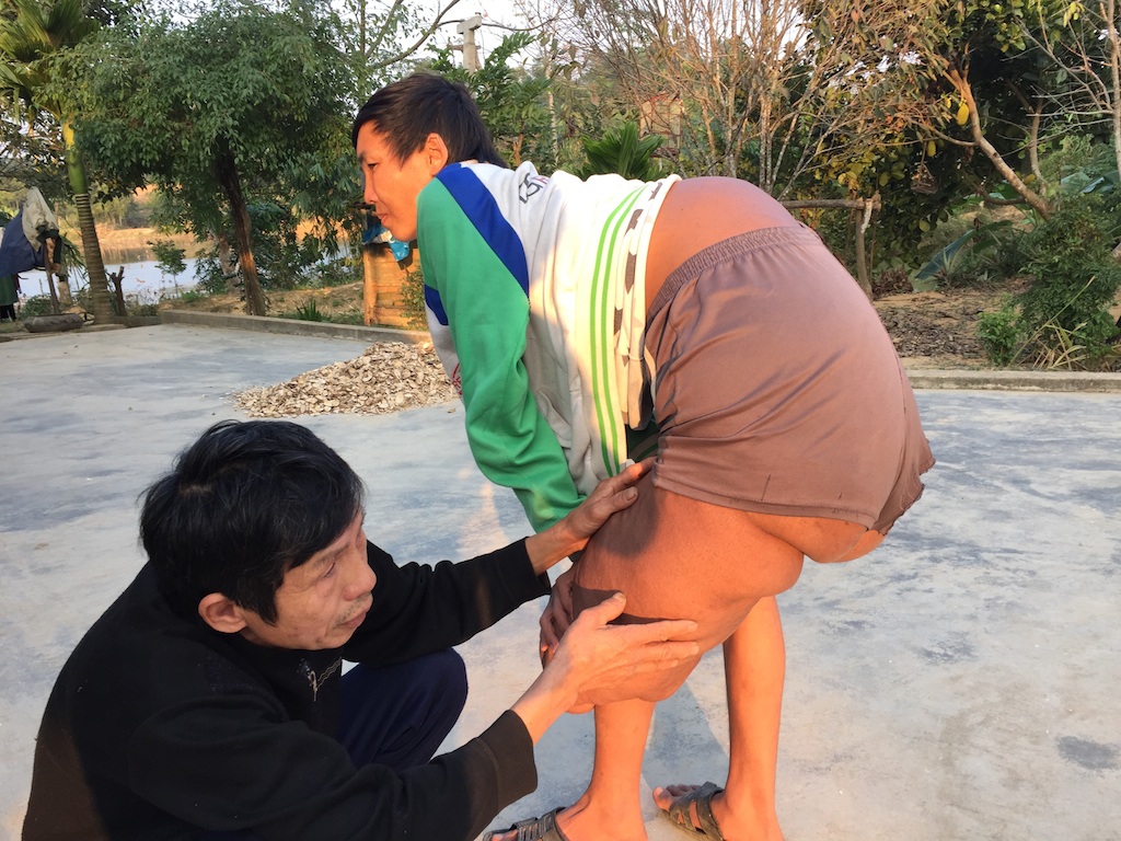 Thương chàng thanh niên "gánh" trên mình khối u nặng hơn 40kg - 7 Khối thịt khổng lồ hơn 40kg Sơn đang phải gánh hằng ngày.