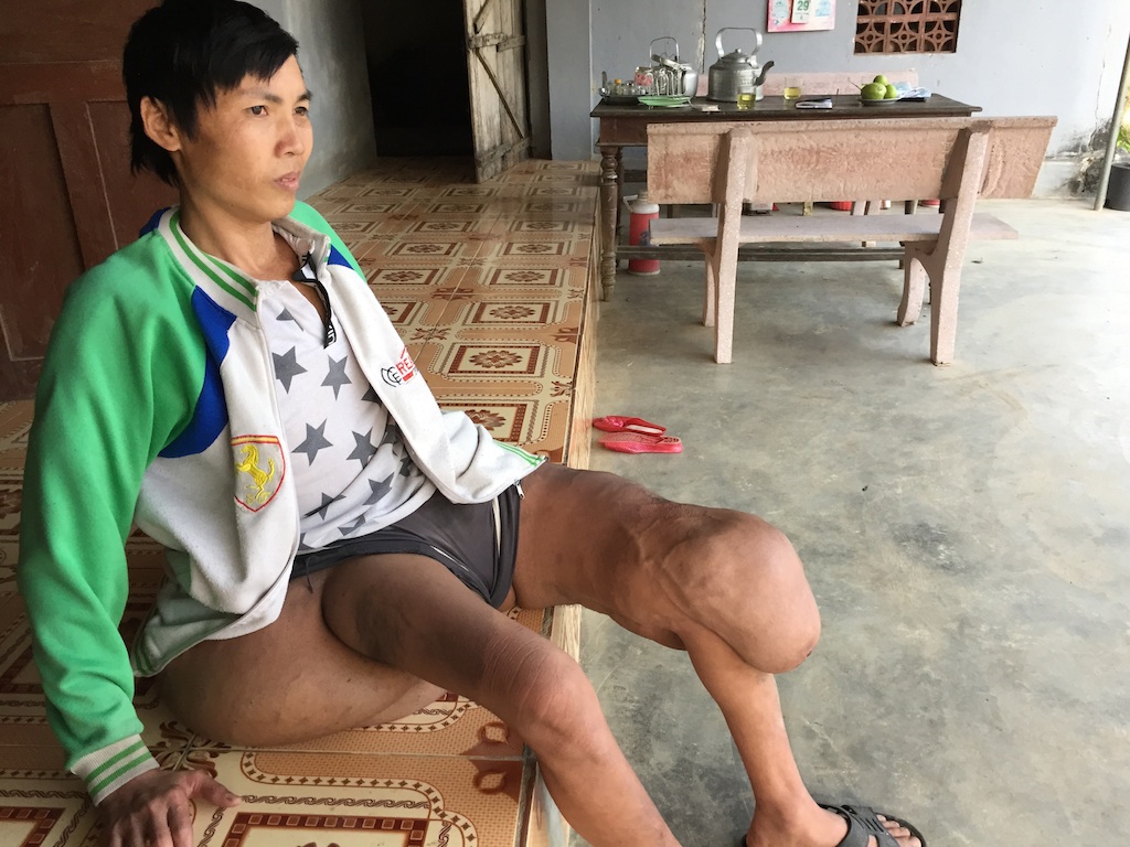 Thương chàng thanh niên "gánh" trên mình khối u nặng hơn 40kg - 1 Sơn luôn khổ đau với thân hình mang khối u khổng lồ.