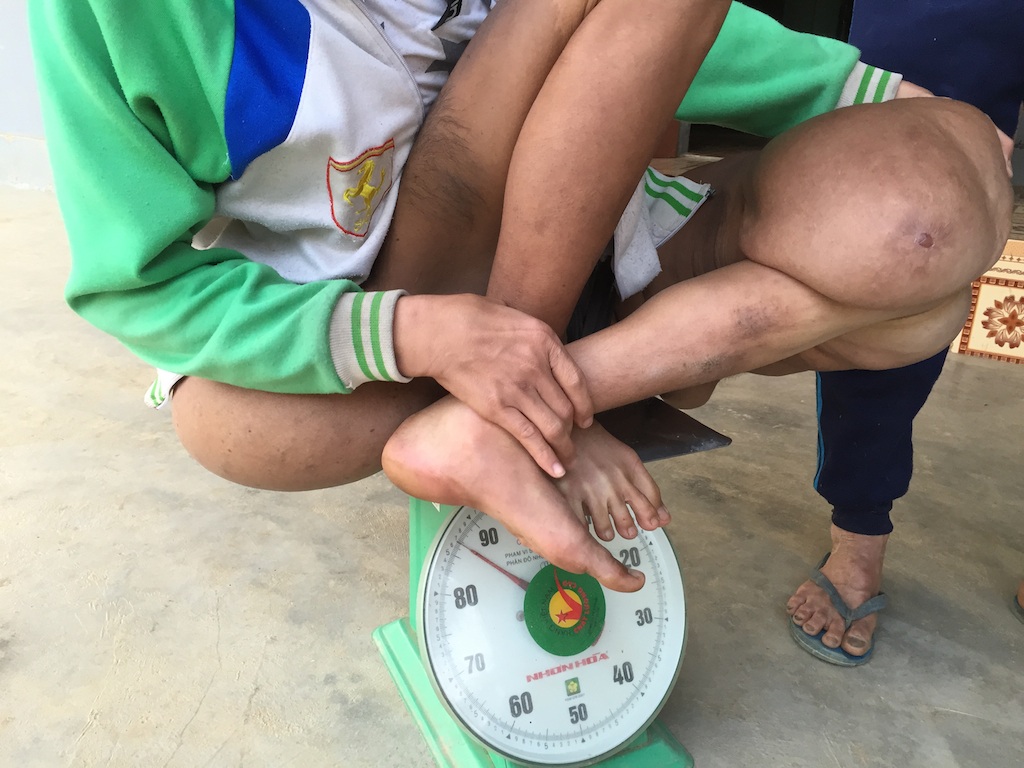 Thương chàng thanh niên "gánh" trên mình khối u nặng hơn 40kg - 5 Sơn ngồi lên chiếc cân với trọng lượng gần 90kg.