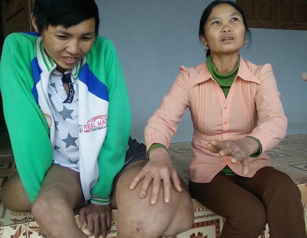 Thương chàng thanh niên "gánh" trên mình khối u nặng hơn 40kg - 2 Bà Hoa - mẹ Sơn buồn lắm khi nhìn con mang cả khối u khổng lồ mà không có cách giải quyết.