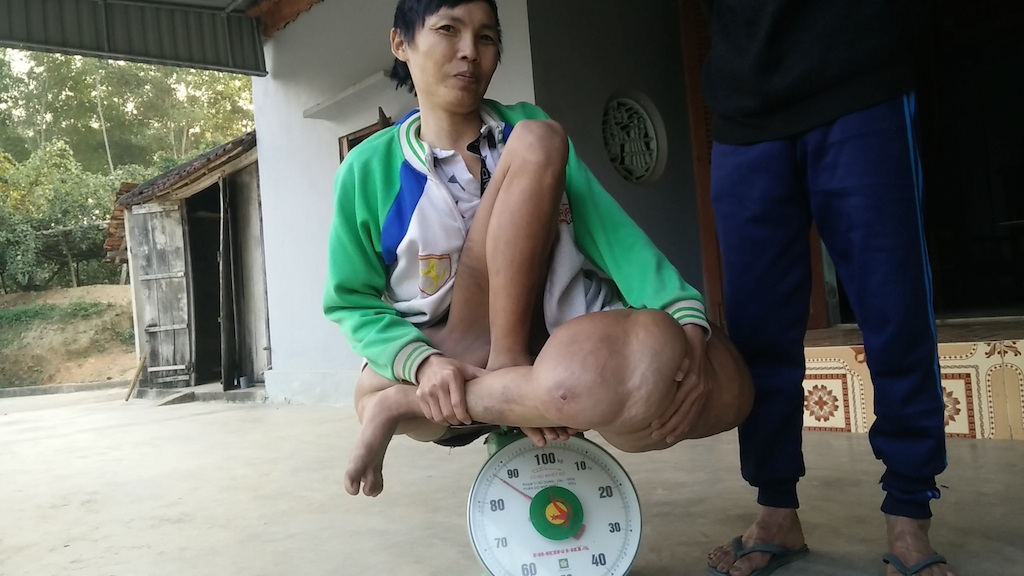 Thương chàng thanh niên "gánh" trên mình khối u nặng hơn 40kg - 4 Sơn ngồi lên chiếc cân với trọng lượng gần 90kg.