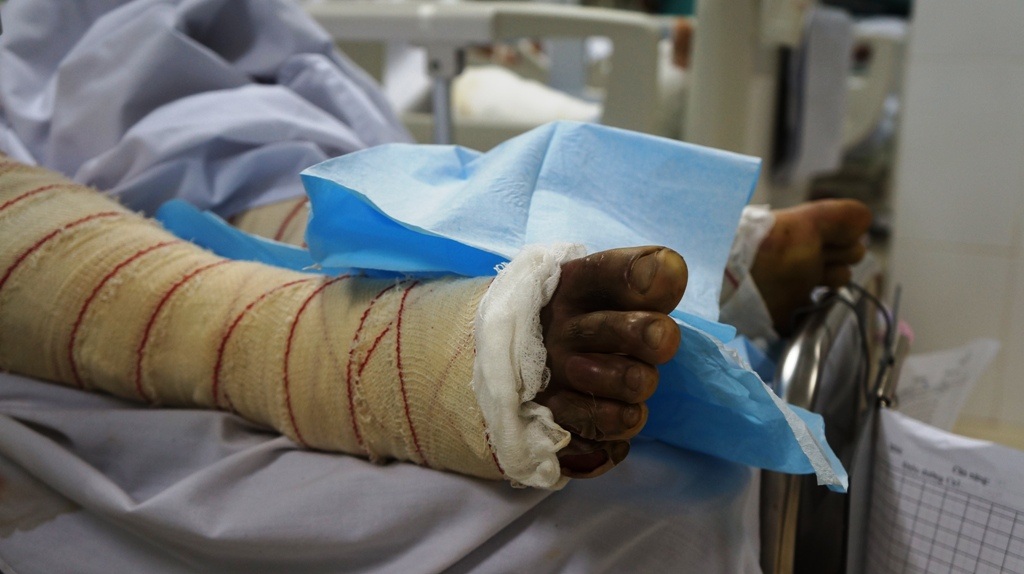 Toàn cơ thể chị Danh bị bỏng độ 3, 4 nặng 70-80%.