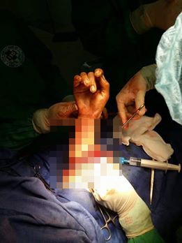 Các bác sỹ BV 115 đã nối lại thành công cánh tay bà Huyên.