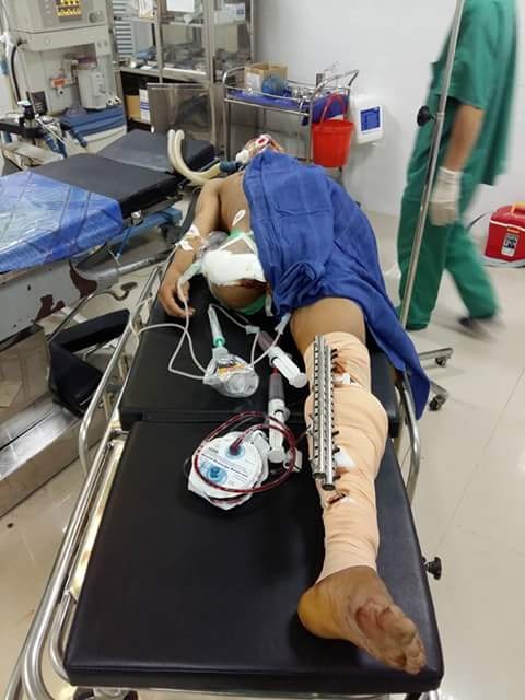 Bệnh nhân Tuấn phải cắt bỏ một chân. 