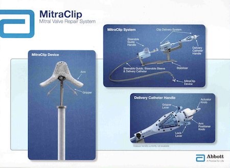 Abbott tiếp tục tăng trưởng trong quý 2 năm 2014 - 1 Toàn bộ hệ thống MitraClip của Abbott Vascular