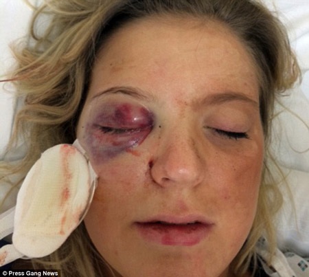 Robinson bị nện vỡ mắt phải.