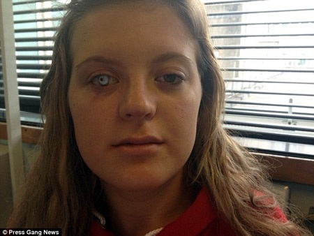 Robinson cho biết các bác sĩ hy vọng khi cơ mắt đã giãn tốt, nó có thể chịu được con mắt giả