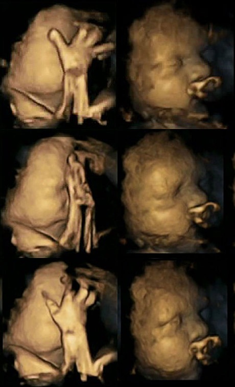 Hình ảnh siêu âm cho thấy mẹ hút thuốc ảnh hưởng đến thai nhi - 1 Hình ảnh siêu âm cho thấy mẹ hút thuốc ảnh hưởng đến thai nhi