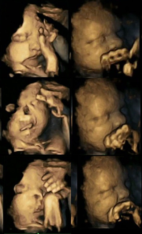 Hình ảnh siêu âm cho thấy mẹ hút thuốc ảnh hưởng đến thai nhi - 2 Hình ảnh siêu âm cho thấy mẹ hút thuốc ảnh hưởng đến thai nhi