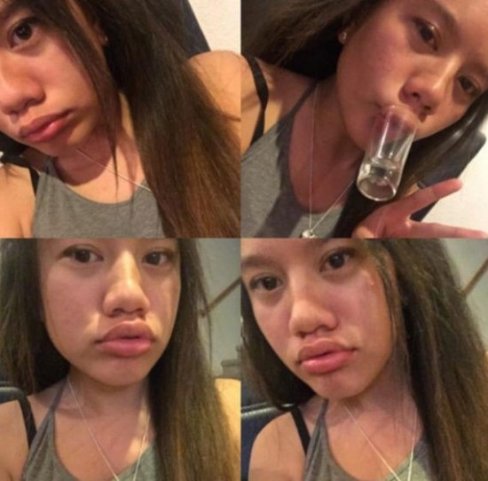 Nút miệng cốc để có "môi vều gợi cảm" - trào lưu điên khùng mới của teen - 2 Nút miệng cốc để có môi vều gợi cảm - trào lưu điên khùng mới của teen