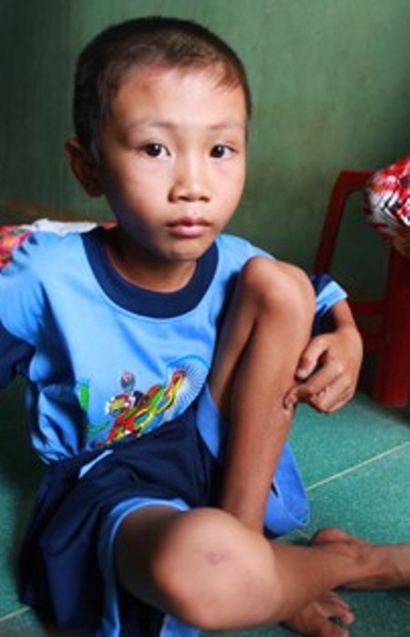Cháu bé bị mẹ kế bạo hành đã vào làng trẻ SOS - 2 Bị đánh đập, nhiều khi bị bỏ đói, trông Toàn ốm nhom - Ảnh: D. Công