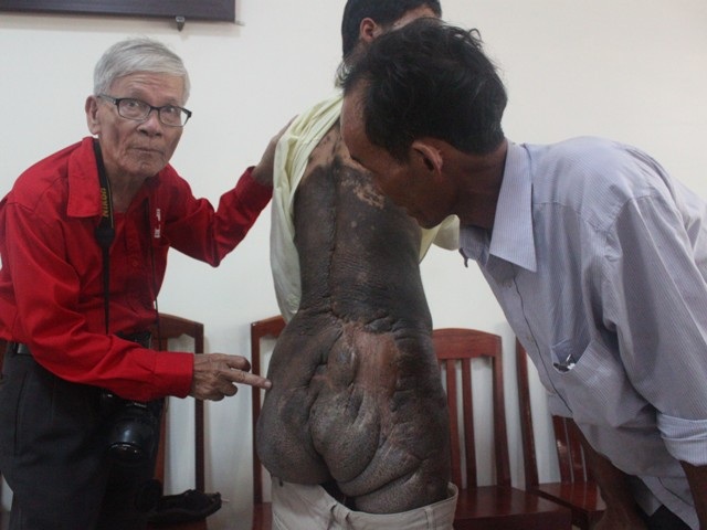 Khối u lành khắp cơ thể nhìn rất khủng khiếp