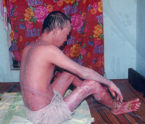 Anh Niên với nhiều chứng bệnh hiểm nghèo