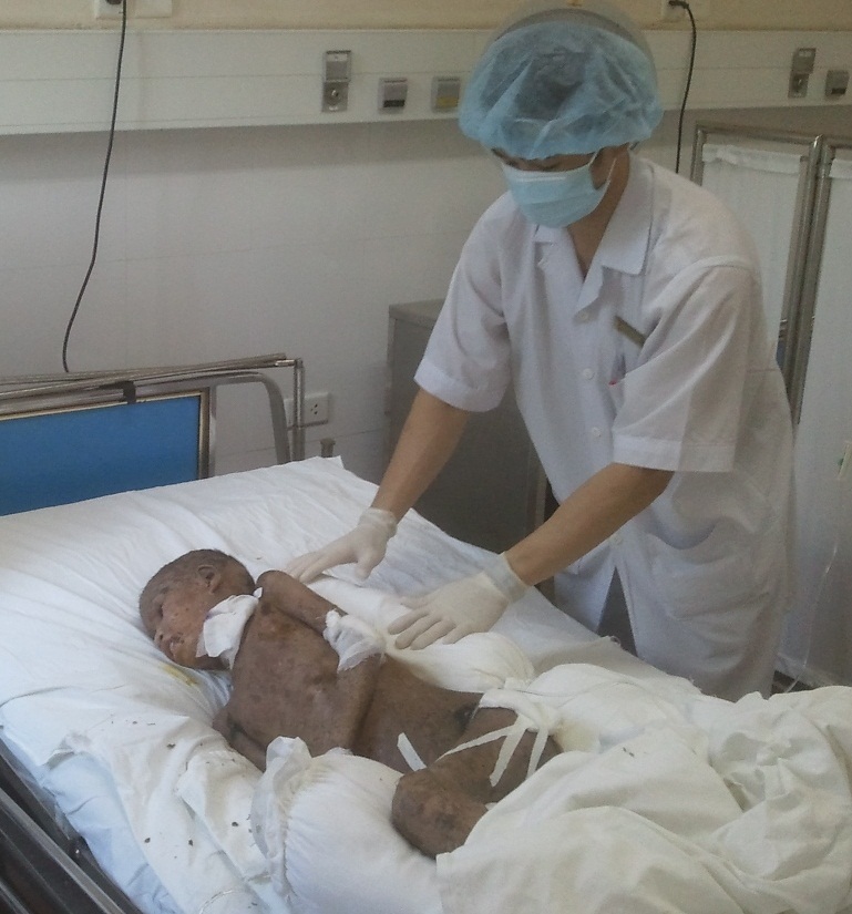 Bé Y Nôn nạn nhân của sự mộng mị của người đồng bào thiểu số đã tạm qua cơn nguy kịch