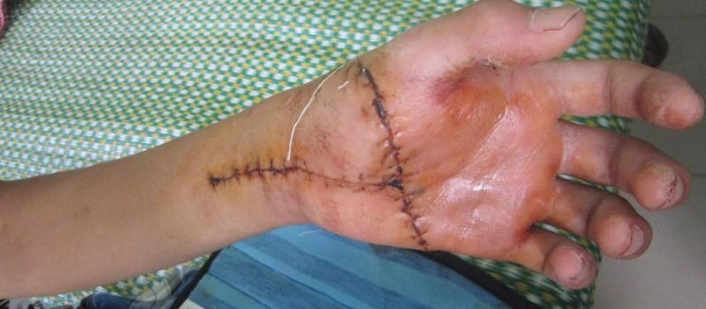Nhiều khuất tất tại bệnh viện đa khoa tỉnh Bình Định - 2 Anh Hạnh (ở huyện Tuy Phước) mổ 4 lần mà không khỏi nên được bác sĩ khuyên cắt chân cho nhanh?