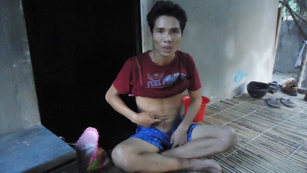 Anh Đinh Văn Dõng và vết mổ ruột thừa đã hồi phục