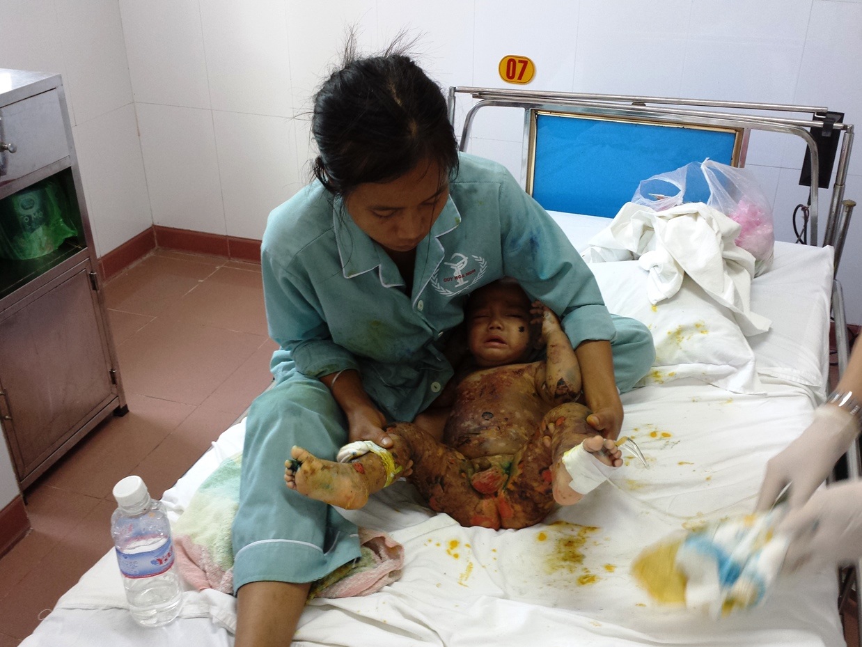 Bé trai 1 tuổi bị lở loét da hiếm gặp - 2 A Phung bệnh nặng nhưng cha mẹ lại rất khó khăn nên nhiều người thương cho tiền mua sữa cho cháu