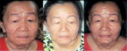 Cô gái hóa bà lão: Bệnh nhân thứ 2 trên thế giới - 2