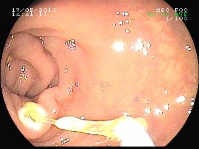 Hình ảnh nội soi ruột già bệnh nhân Trần Thái T.