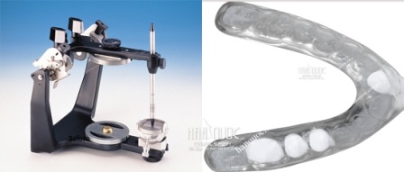 Phẫu thuật cắt hàm hô, móm 1 lần duy nhất - 4 Giá khớp chỉnh hàm Máng hướng dẫn phẫu thuật